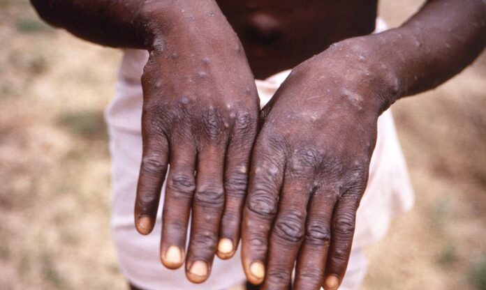2022-05-18t225151z_1_lynxnpei4h16e_rtroptp_4_health-monkeypox